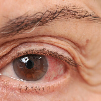 Common Eye Conditions that Occur with Age
