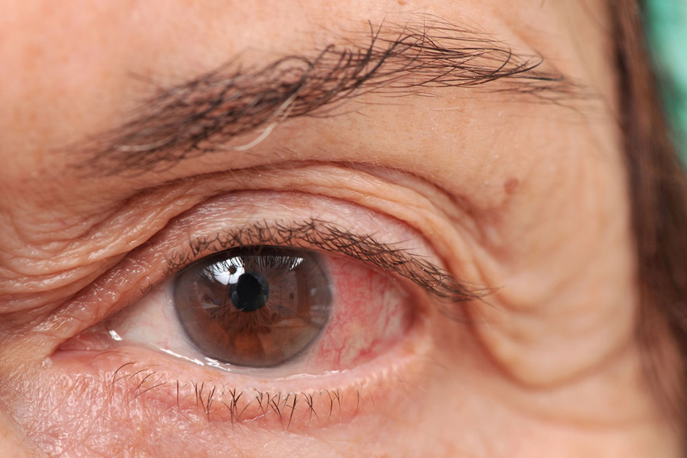 Common Eye Conditions that Occur with Age
