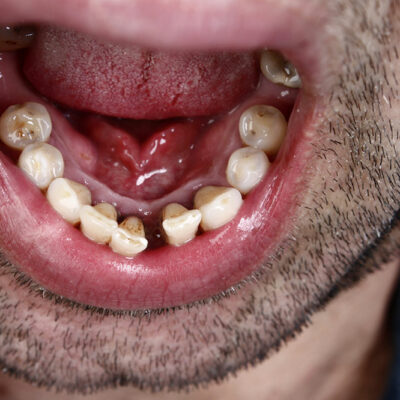 Causes and Treatment Methods of Oral Cancer