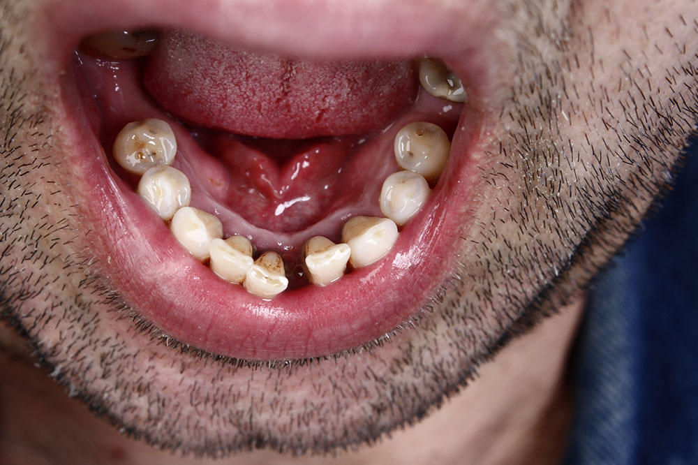 Causes and Treatment Methods of Oral Cancer