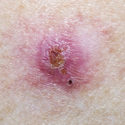 Different Types of Skin Ulcers
