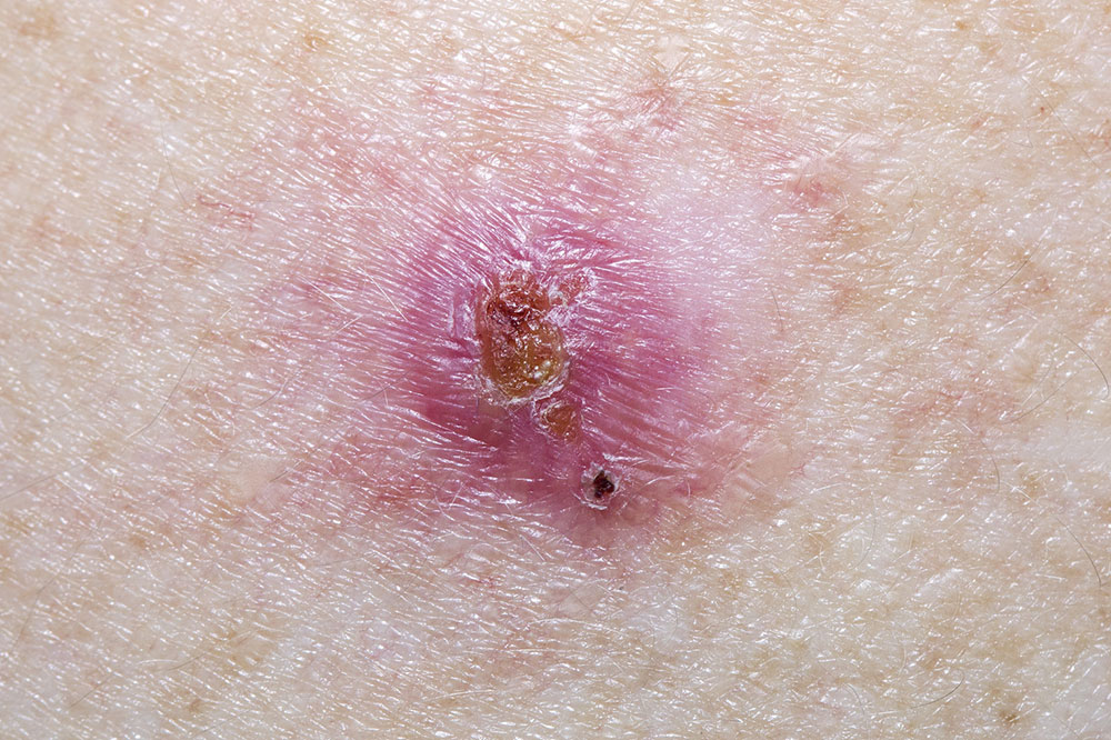 Different Types of Skin Ulcers