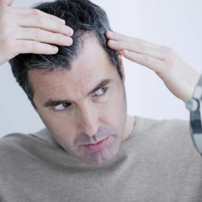 How to Treat Male Pattern Baldness