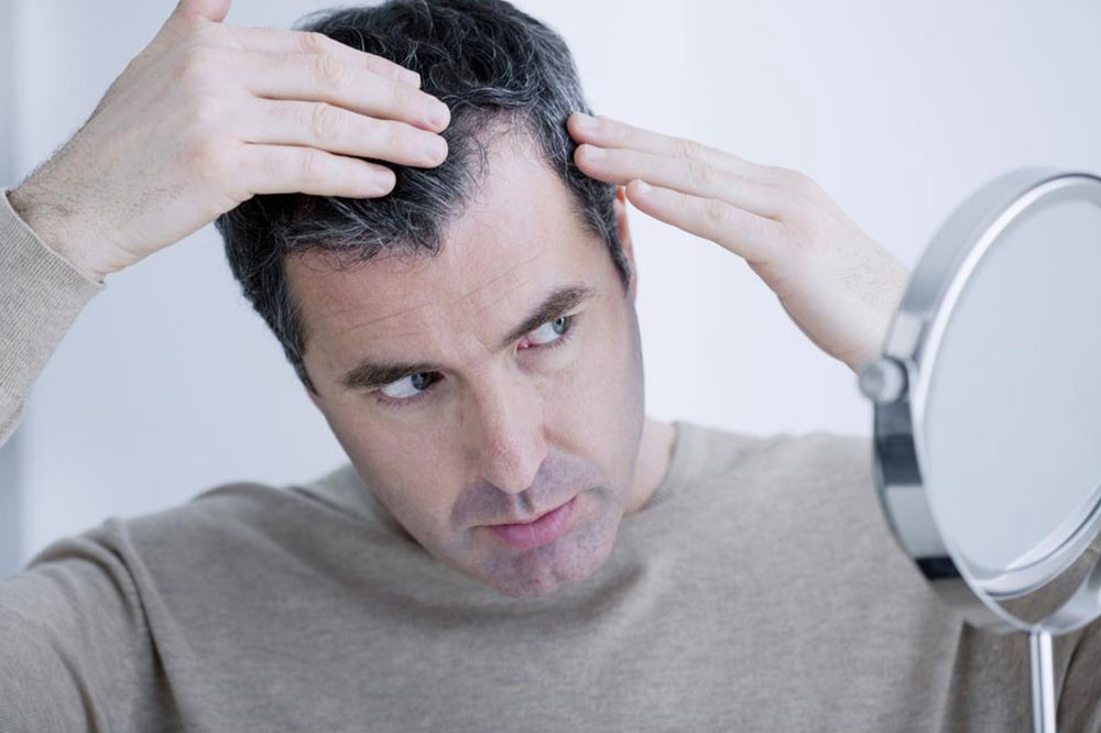 How to Treat Male Pattern Baldness