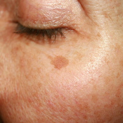 Signs of Melanoma and Treatment Options