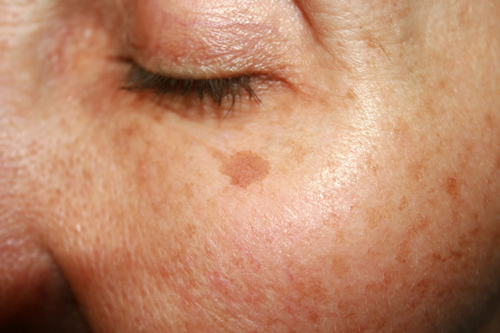 Signs of Melanoma and Treatment Options