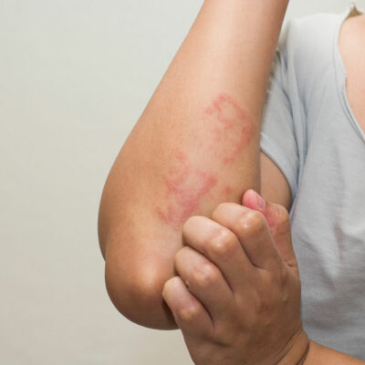 Types of Skin Allergies and Their Causes