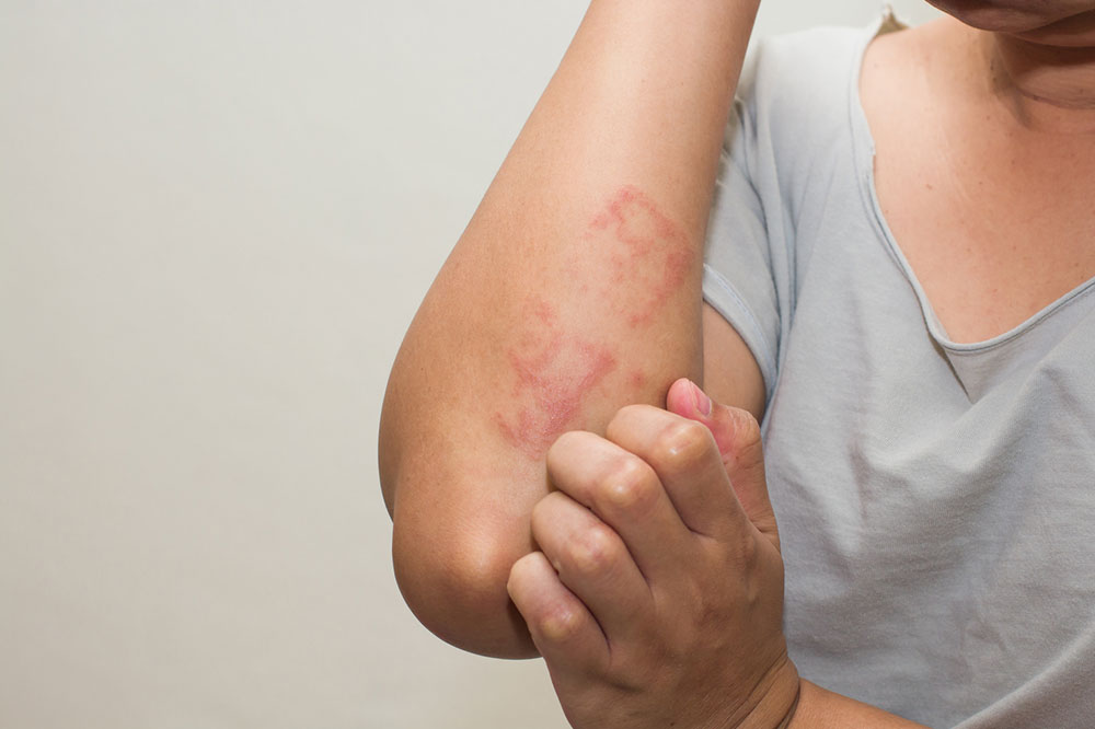 Types of Skin Allergies and Their Causes